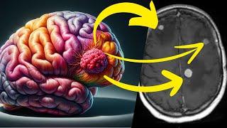 Brain Tumors - A Masterclass in Medicine For Metastatic Cancer In The Brain