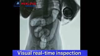 Perlove DRF helping treat intussusception on children