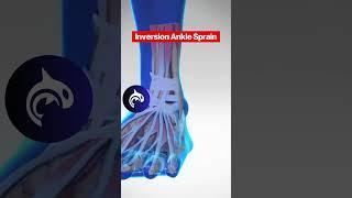 Eversion Ankle Sprain vs Inversion Ankle Sprain