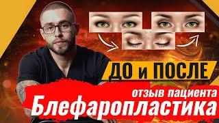 Блефаропластика отзыв пациента: чего боятся перед операцией? Результат до после