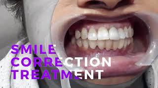 Smile Correction| Fixed Partial Denture |Fixed Teeth|Dental Prosthesis|Cosmogene|Kolkata