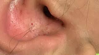 Ear blackheads. Ear extractions. Concha pops. Cleaning out the ear, mining the pores. MrPopZit.