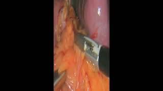 Laparoscopic Splenectomy By Wael Tobar MD