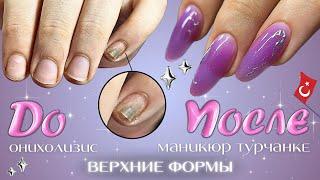 маникюр турчанке  онихолизис, наращивание на верхние формы, эффект jelly nails 