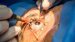 Unhappy Multifocal Patient: Intraocular Lens Exchange after Cataract Surgery