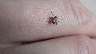 Как вытащить клеща Если укусил клещ Эксперимент над клещем How to pull a tick Поддубные