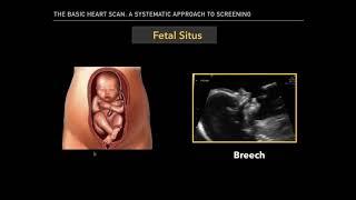 The Basic Fetal Heart Scan