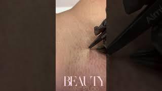 Ingrown Hair Removal