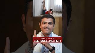 FAST Relief for Swollen Legs in 2024!