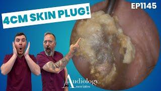 4cm Keratin Plug Removed – Deep Ear Skin Extraction! - EP1145