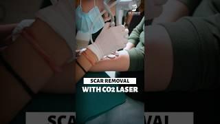 Scar Removal Co2 Laser | Co2 Laser Treatment for Scars | Skin Specialis, Rishikesh | Dr.Sridevi