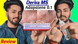 Blackheads, Acne Removal Adapalene Gel | Deriva MS Gel Review