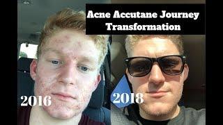 My 8 Month Accutane Transformation