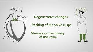 Symptoms of aortic valve stenosis