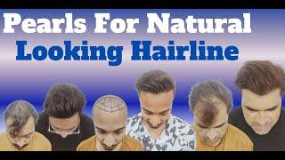 Hair Transplant in indore | Best Results & Cost of Hair Transplant in indore