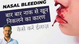 नाक से खून निकलने के कारण । Cause of Nasal Bleeding / Epistexis