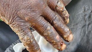 Otupa's hands more jiggers than feet - see long video @riseupsociety.net ($10, subscribe)