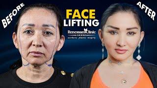 FACE LIFTING - ПОДТЯЖКА ЛИЦА - YUZ TORTTIRISH