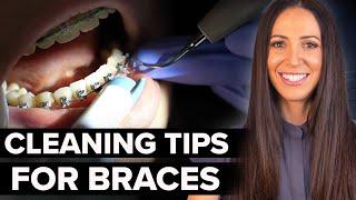 Tips for Cleaning Braces (for dental hygienists)