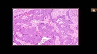 2022 07 25 Differentials for Small Round Blue Cell Tumors of the Sinonasal Tract