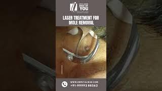 Mole Removal By Laser Treatment | Watch Till End | Mole Removal Treatment in Delhi | Dr. PK Talwar