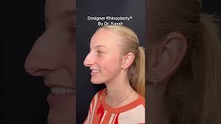 Nose Job Transformation  #nosejobnyc #nycplasticsurgeon #njplasticsurgeon #nycnosejob #njnosejob