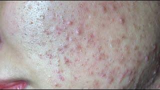 Make your Acne Treatment Huong Da Nang#520  | acne 2023