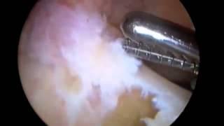 All Inside ACL Reconstruction: Dr. Brett Sanders