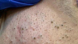 Luna Natural Remedies For Acne (Clear Skin Solutions)