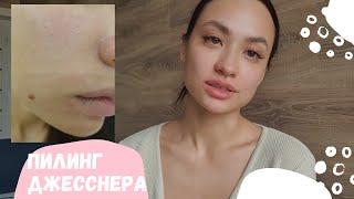 Пилинг Джесснера (Jessner peeling) Ожидание/реальность