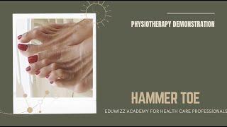 EDUWIZZ ACADEMY PHYSIOTHERAPY ONLINE DEMO CLASS | HAMMER TOE | ANDROID APP