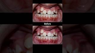 20 months Braces Transformation #braces #dentist #orthodontist #dental