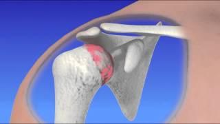 Total Shoulder Replacement