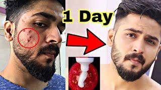 Pimples Kyu Hote hai ? pimple Kaise Thik Kare | Remove Pimples #hunkharsh #pimples #acne #skin