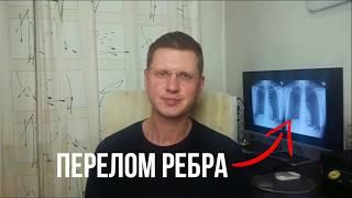 Как лечить перелом ребра?