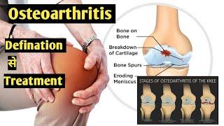 OSTEOARTHRITIS गठिया कैसे ठीक करे|Causes|Symptoms|grade0-4|Dr F.A khan part-2