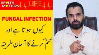 Fungal Infection Treatment - Fungal Infection of Skin In Urdu/Hindi - Fungus Ka Ilaj