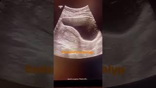 endometrial polyp##learning #ultrasound #imaging #medicalimaging