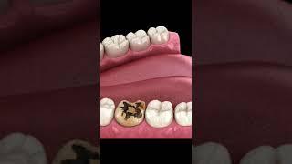 Caries Removing and Crown