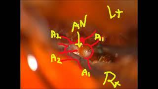 SAH, Acom aneurysm, Pterional approach