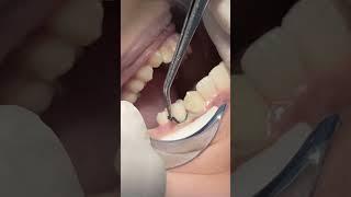 Class V composite restoration #dentist