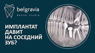  Имплантат давит на соседний зуб? Осложнения после имплантации