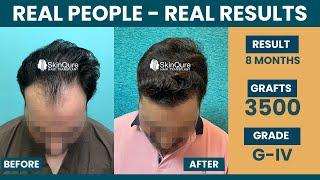 Hair Transplant in Delhi | Best Results | Hair Transplant cost in Delhi | Dr Jangid