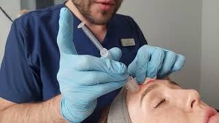 Skinko-E Mesotherapy With Turtle Pin III in Oxford