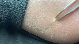 Satisfying Splinter removal