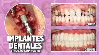 Implantes dentales - Formación en Implantología -