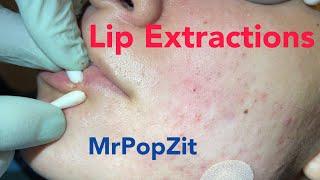 Lip extractions. Whiteheads, blackheads, acne extractions on face. Inflammatory pustules.