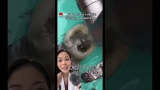 Removing a silver filling. #silverfilling #amalgam #cavity #dentist