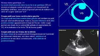 échographie transoesophagienne