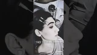 Facc Thread Lift Treatment by Dr Ahsan Riaz at Plasthetics clinic Johar Town Lahore